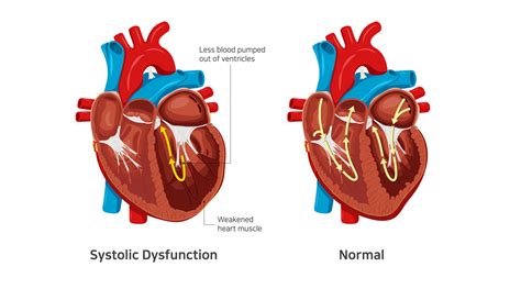 severe left ventricular systolic dysfunction.